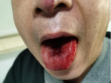 During the treatment process