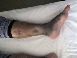 Mr. Zhang's skin ulceration on both legs before treatment