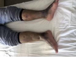 Mr. Zhang's bilateral lower limb edema subsided