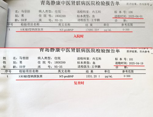 A Nephrotic Syndrome Patient Did 2 Things Right and Reduced 27 kg of Edema in 3 Weeks