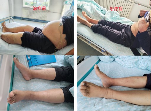 Mr. Ma before and after edema reduction