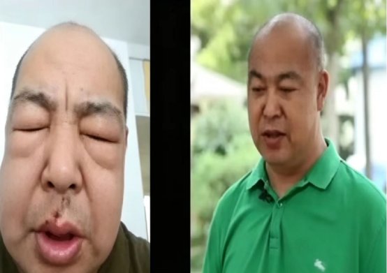 Jingkang TCM Snatches a Severe Nephrotic Syndrome Patient Back from the 