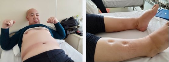 Mr. Chen before and after edema reduction comparison